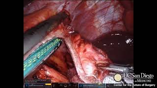 Robotics to the Rescue: Revisional Bariatric Surgery