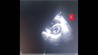 echocardiography of pulmonary hypertension (PHT) , cor pulmonale