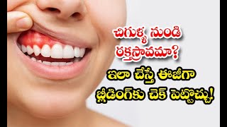 How To Get Rid Of Bleeding Gums At Home Details - చిగుళ్ళ నుండి రక్తస్రావమా? ఇలా చేస్తే ఈజీగా బ్లీ