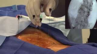 Medial Branch Block Demonstration - LIVE!