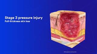 Pressure Injury Education: Chapter 3 Staging