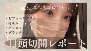 〔美容vlog〕垢抜けたい美容オタクによる目頭切開レポート/✍️クリニック / Q\u0026A  / ダウンタイム公開