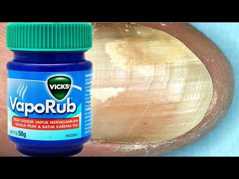 How To Treat Toenail Fungus With VICKS VAPORUB How To Treat Toenail Fungus With VICKS VAPORUB