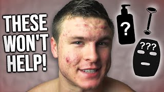 5 Things That AREN'T Helping Your Acne!
