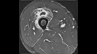 Myositis Ossificans (Narrated Professionally)