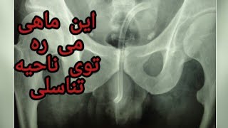 🔞  ماهی که از راه آلت تناسلی وارد بدن انسان می شود | بررسی انگل کاندیرو