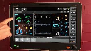 Mindray SV800 Auto mode AMV: Adaptive Minute Ventilation