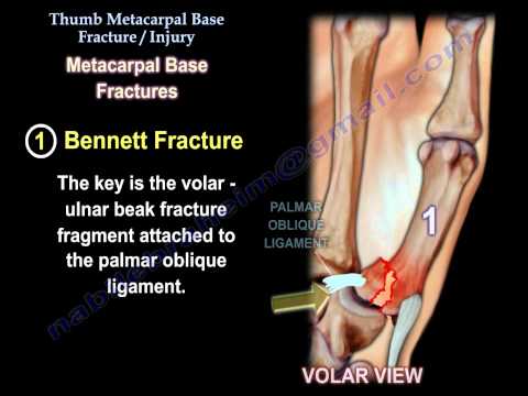 Thumb Metacarpal Base Fracture Injury - Everything You Need To Know - Dr. Nabil Ebraheim Thumb Metacarpal Base Fracture Injury - Everything You Need To Know - Dr. Nabil Ebraheim