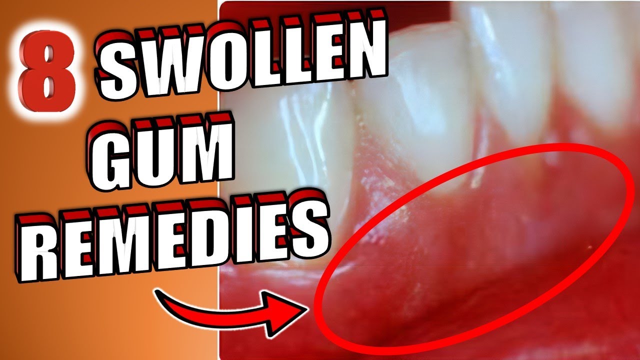 8 Home Remedies To Get Rid Of Swollen Gums - YouTube