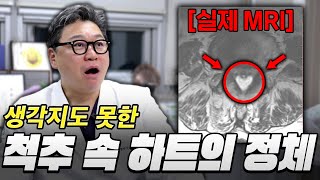 척추에서 ❤ 제거해드렸더니 편안하게 걸으십니다｜후관절낭종 치료 소개｜양재 참포도나무병원 신경외과 전문의 이동엽 원장