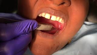 Wisdom tooth or third molar removal surgery in Richardsons dental and Craniofacial hospital