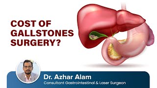 Cost of Gallstone Surgery | Dr Azhar Alam