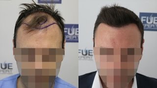 FUE Hair Transplant (3500 Grafts in NW Class lV-A) Dr. Juan Couto - FUEXPERT CLINIC- Madrid, Spain