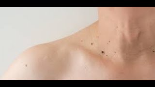 ቆዳ ላይ የሚወጣ Skin tag በቀላሉ በ ቤት ውስጥ ማስወገጃ ውህድ (Skin Tag remover)