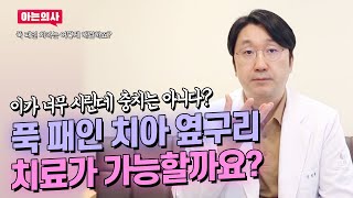 충치가 아니어도 이가 시릴 수 있다! 원인부터 접근하는 치아패임 치료방법