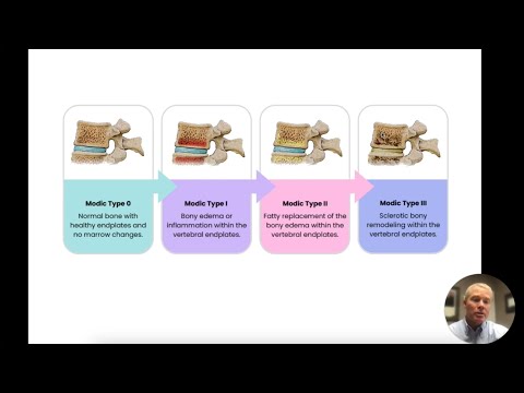 What is end plate degenerative changes?