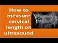 How to Measure Cervical Length by Ultrasound