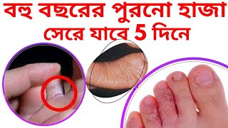 পুরনো হাজা চুলকানি থেকে মুক্তি 5 দিনে | Home remedies to get rid of tinea pedis,Monsoon skin disease