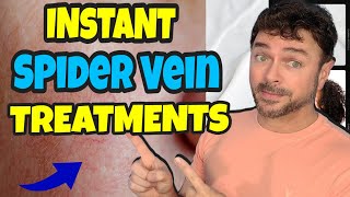 5 Ways To Treat Spider Veins with INSTANT RESULTS! | Chris Gibson