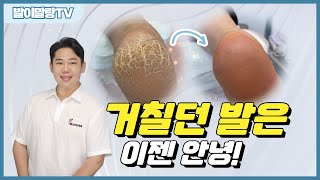 발각질제거 스케일링 관리로 여름발관리 걱정 고민끝