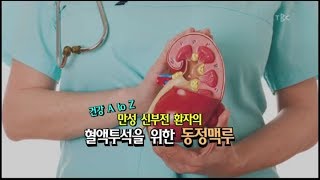 [TBC클리닉 건강365]만성 신부전 환자의 혈액투석을 위한 동정맥루/TBC