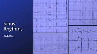 Sinus Rhythms: ECG Atlas