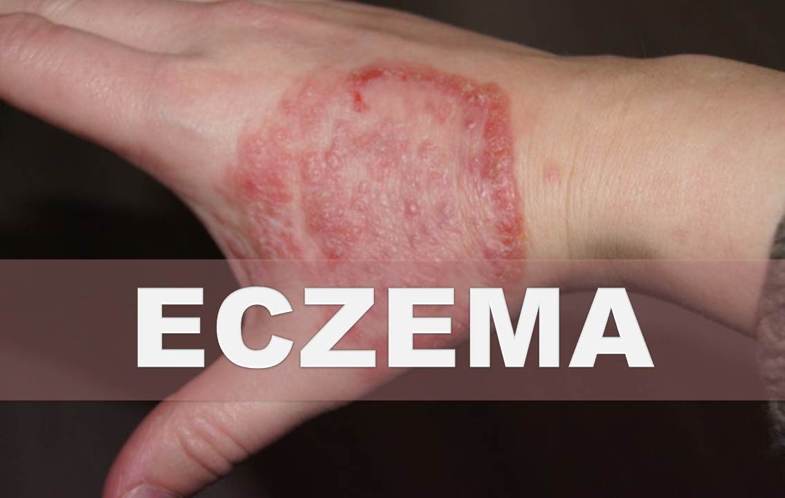 Remedios Caseros Para La Eczema – Como Aliviar La Piel Seca, Escamosa E ...