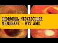 Choroidal neovascular membrane (CNV) | Wet AMD | TYPE 1 CNVM, type 2 CNVM, type 3 CNVM ,RAP