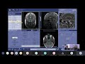 learn about the latest innovations in neuro imaging on the signa™ architect mr