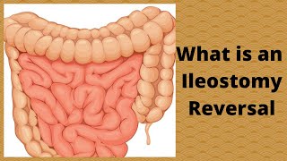 What is an Ileostomy Reversal