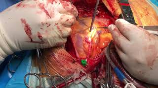 coronary artery bypass graft (CABG)