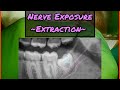 Nerve Exposure with Wisdom Tooth Extraction Step by Step @drwahan