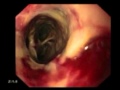 Carcinoma of esophagus + TOF+ SEMS placement