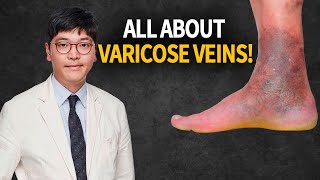 Varicose Veins The Facts You Need to Know!