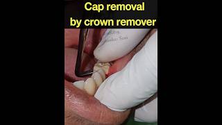 दाँत का कैप कैसे निकाला जाता है?cap removal, How to use crown remover #shorts #dentalshorts