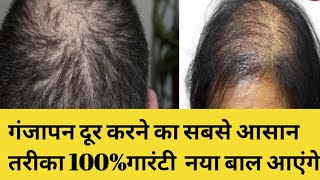 गंजापन दूर करने का सबसे आसान तरीका : गंजे सिर पर भी आ जाएंगे बाल || 100% गारंटी