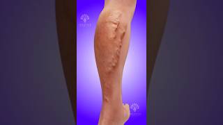 How Varicose Veins Develop Shorts Viralvideo Creativelearning3d