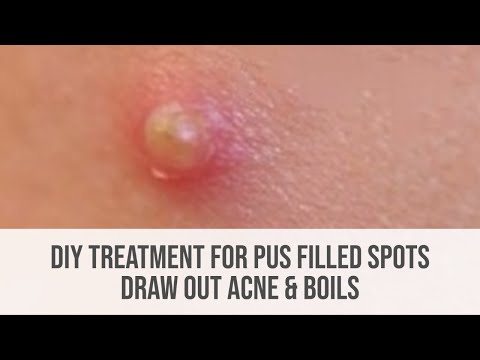 DIY Treatment For Pus Filled Spots (Draw Out Acne & Boils) DIY Treatment For Pus Filled Spots (Draw Out Acne & Boils)