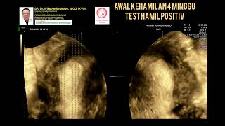 Awal hamil muda 4 minggu penebalan endometrium reaksi desidualisasi