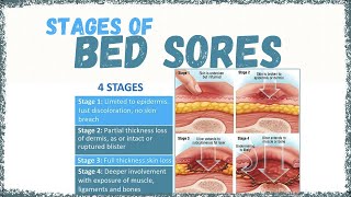 Bed Sores: Stages [Pressure sores, Pressure ulcers]