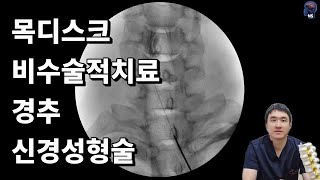 경추 신경성형술! (Cervical percutaneous epidural neuroplasty)