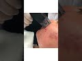 Before and After Morpheus8 for Acne | Dr.  Kami Parsa, M.D.