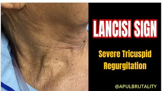 Lancisi sign (prominent jugular C-V wave) in severe tricuspid regurgitation (TR)