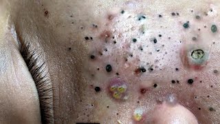 Big Cystic Acne Blackheads Extraction Blackheads \u0026 Milia, Whiteheads Removal Pimple Popping # 1636