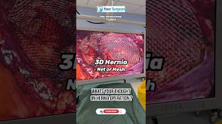 3D HERNIA NET ? Most Advanced Robotic and Laparoscopic Hernia treatment in India I Gujarat I Surat