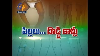 పిల్లలు... దొడ్డి కాళ్లు| సుఖీభవ |28 డిసెంబర్ 2018| ఈటీవీ తెలంగాణ