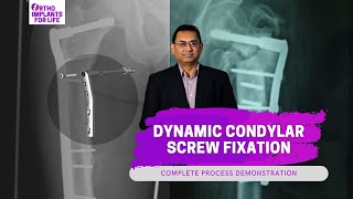 Dynamic Condylar Screw Fixation Procedure