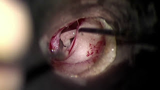 Stapedotomy Ear Surgery to Treat Otosclerosis