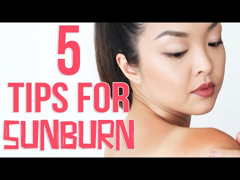 HOW TO: Get Rid of Sunburn FAST! HOW TO: Get Rid of Sunburn FAST!