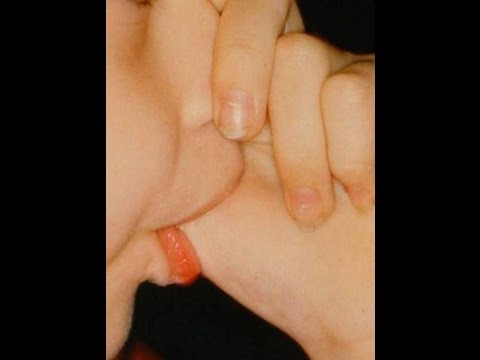Thumb Sucking Habit and How to Stop It Thumb Sucking Habit and How to Stop It